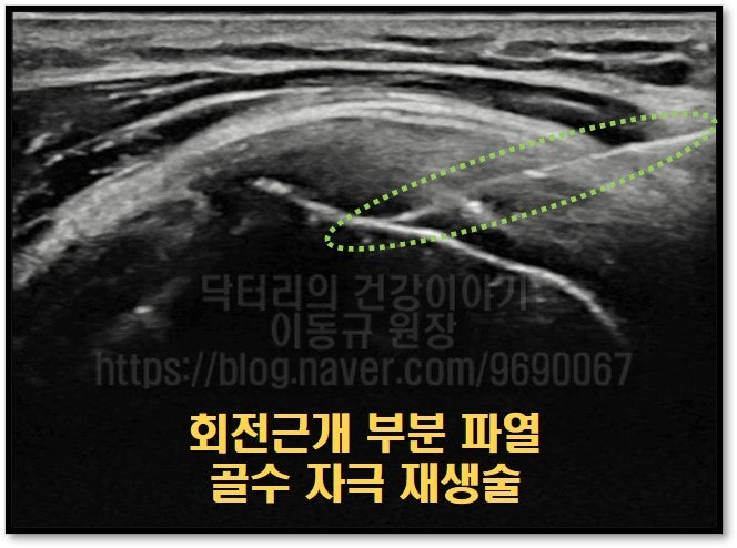 초음파를 통해 정확한 위치를 타겟팅하고 주사기를 삽입하여 골수 자극 재생술 을 시행하였습니다.