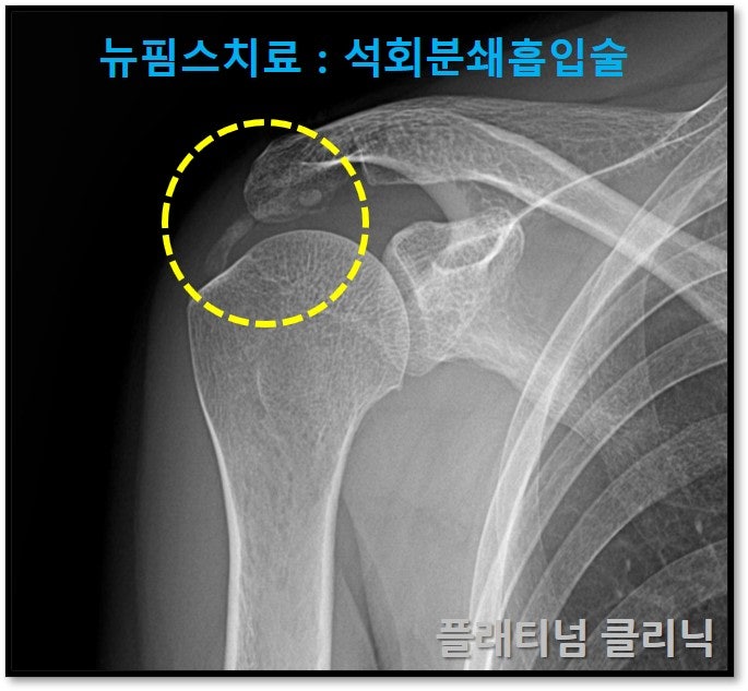 노란색 원 안에 커다란 석회가 관찰됩니다. 거의 3cm 에 가까운 커다란 석회가 관찰됩니다.