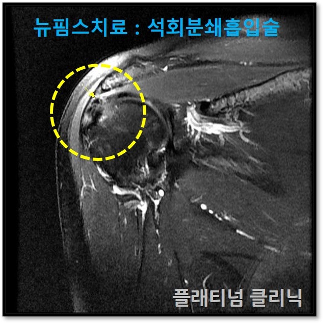 MRI 상에서 다른 부위의 문제는 없고 석회성 건염만 확인되었습니다.
