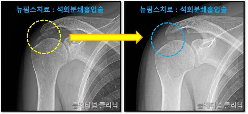 시술 결과를 비교. 확인해 보면 더 확실하게 석회가 제거된 것이 보입니다.