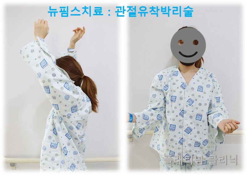 시술전 좌측 견관절 가동범위 제한이 심하였고 전방거상 및 외회전 제한이 심한 상태입니다.