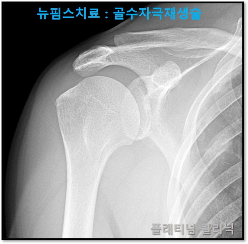 X-ray 상에서는 특이소견이 없었습니다.