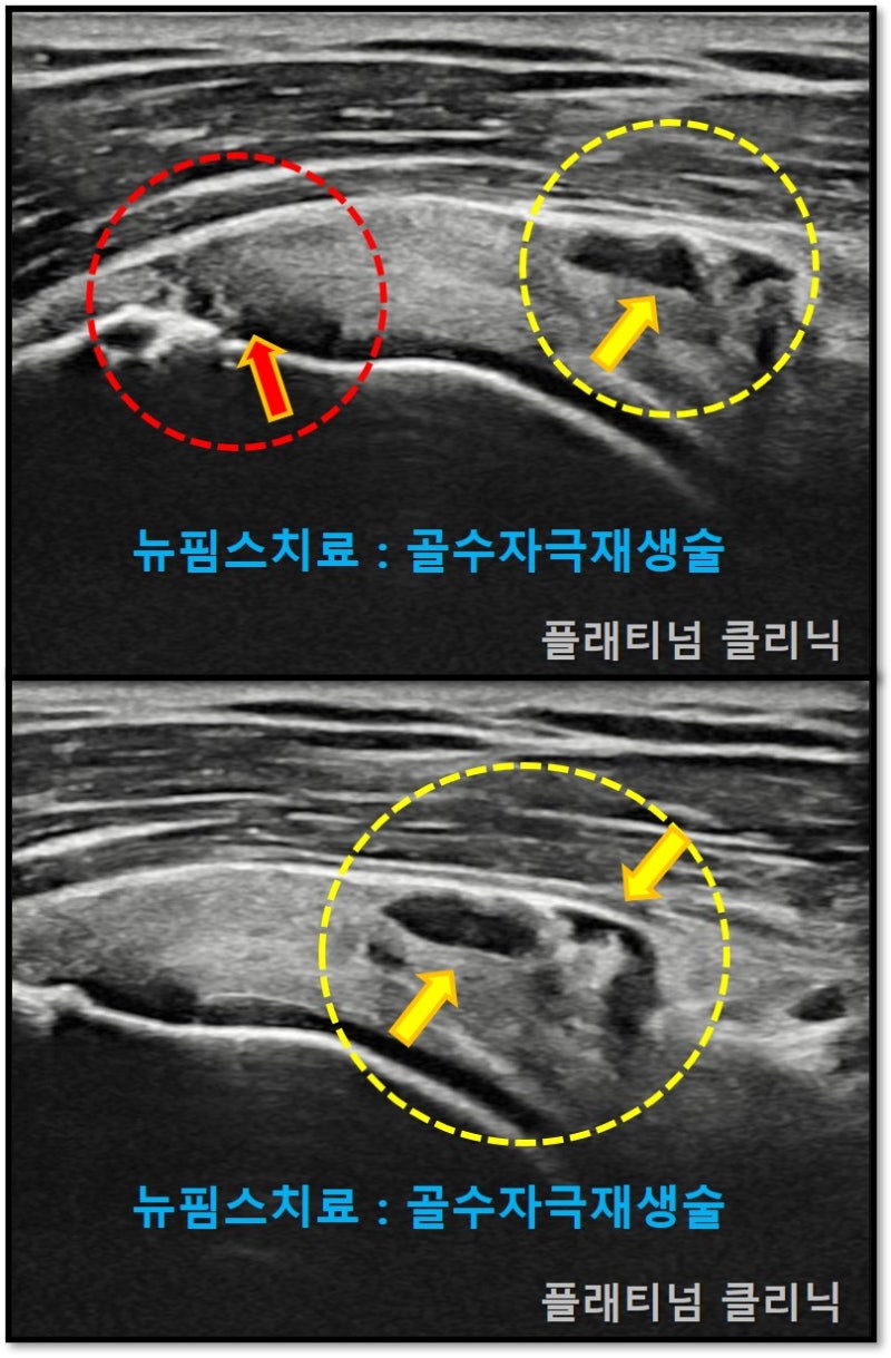빨간 원안에 화살표에서 보이듯 회전근개의 부분 파열이 관찰됩니다. 또한 노란 원안에 화상표에서 보이듯 힘줄의 중간부위의 부분파열도 같이 동반된 상태입니다.