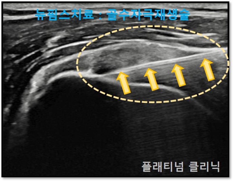 화살표로 표시된 것이 특수한 침이며 정확하게 손상부위를 타겟팅하여 골수자극재생술을 시행하였습니다.