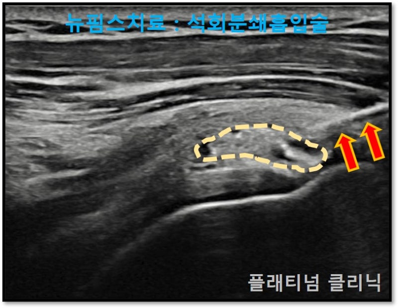 빨간 화살표로 표시된 부위가 주사기의 모습이며 노란 점선으로 표시된 것이 석회이고 주사기를 이용하여 석회를 분쇄 흡입하였습니다.