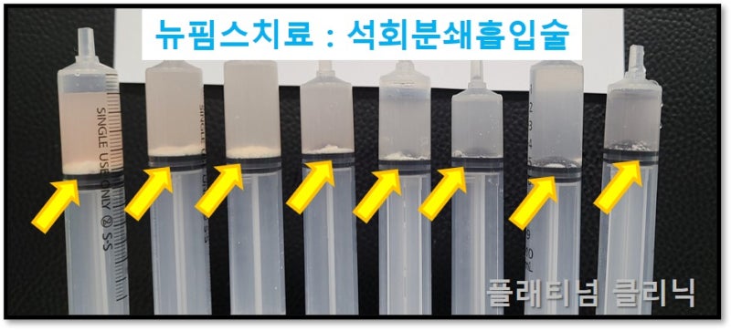 뉴핌스:석회분쇄흡입술 후 주사기 사진을 보면 주사기 아래쪽으로 화살표로 표시된 부위의 하얀것이 석회입니다.