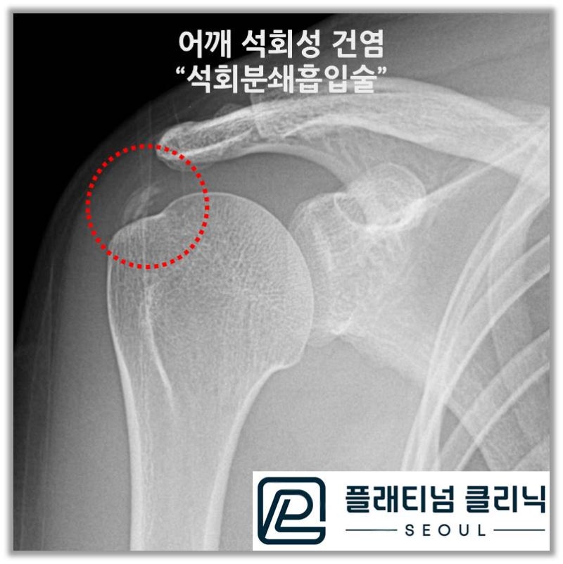 빨간 원안에 하얀 석회가 관찰됩니다. 충격파를 수십차례 해서인지 석회가 약간 흐트러져 있는 것이 관찰됩니다.