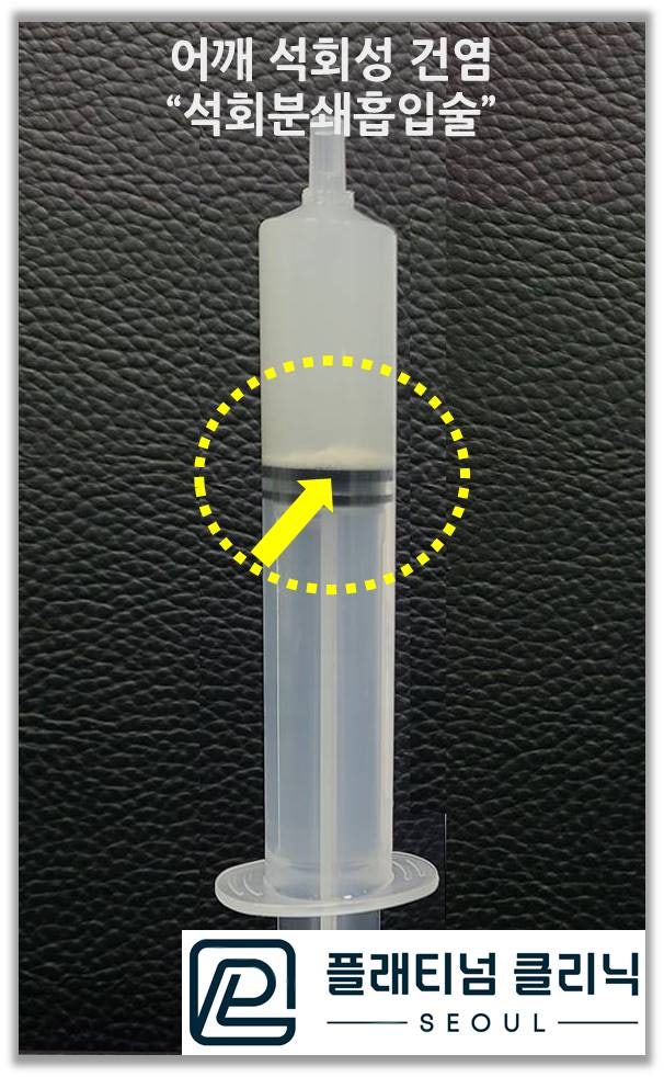 시술 후 주사기 사진을 보면 주사기 안에 하얗게 침착된 것이 석회입니다.