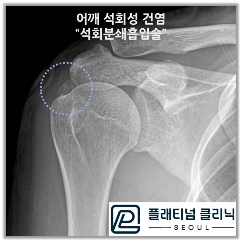 시술후 파란 원안에 이전에 보이던 석회가 많이 감소된 것이 관찰됩니다.