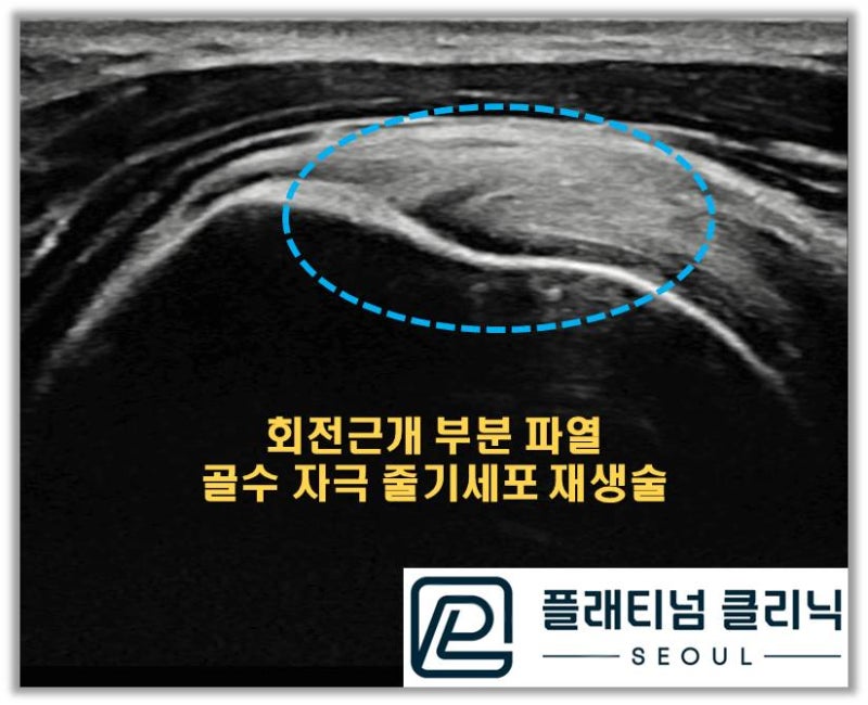 시술전 초음파에서 검게 보였던 부위가 거의 정상에 가깝게 회복된 것이 관찰됩니다.