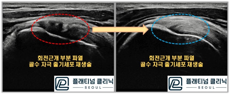 골수자극 줄기세포 재생술 을 시행한 시술 전 후 사진 입니다.