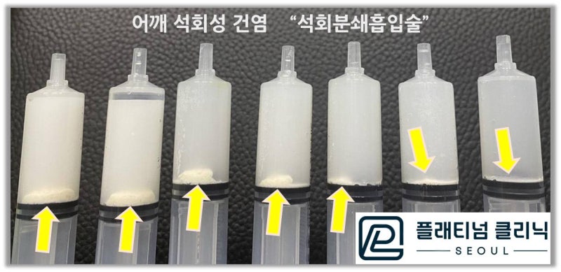 시술하고 나서 주사기 사진을 보면 주사기 밑으로 햐얗게 가라앉은 석회가 관찰됩니다.