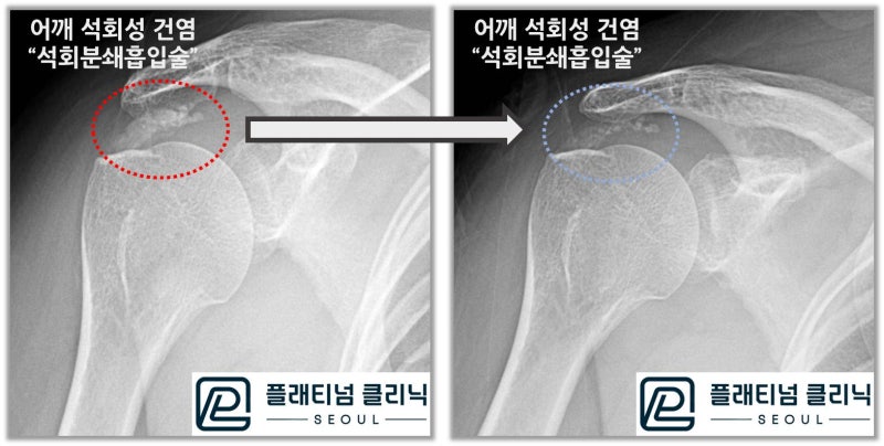 시술 전 후 X-ray 를 보면 석회가 많이 없어진 것이 관찰됩니다.