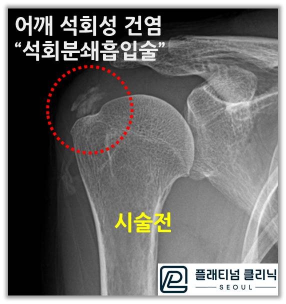 빨간 원안에 상완골 위로 하얗게 보이는 석회가 관찰됩니다. 석회가 깨끗하게 있지 않고 여러군데로 퍼져있는 양상으로 관찰됩니다.