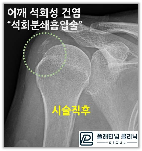 시술직후 사진을 보면 시술 전 보다 석회가 상당히 감소된 것이 관찰됩니다.