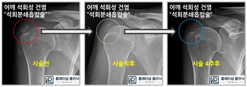 원안에 석회가 점점 더 없어지는 것이 관찰됩니다.