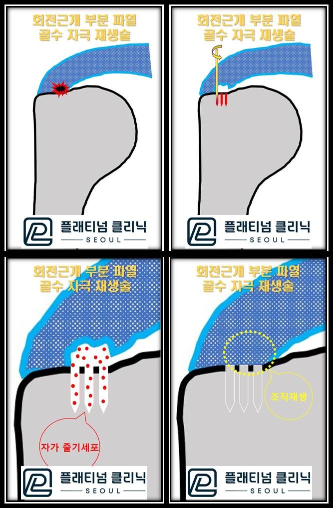 골수자극 줄기세포 재생술은 회전근개 부분 파열이 있을깨 부위마취를 통해 어깨 통증을 제어한 상태에서 파열된 부위에 미세한 구멍을 뼈에 만듭니다. 이 구멍을 통해 골수나 흘러나오게 되며 이 골수 속에는 수많은 줄기세포와 치유세포가 분비되며 시간이 지나면서 손상된 회전근개가 치유되는 치료법입니다.