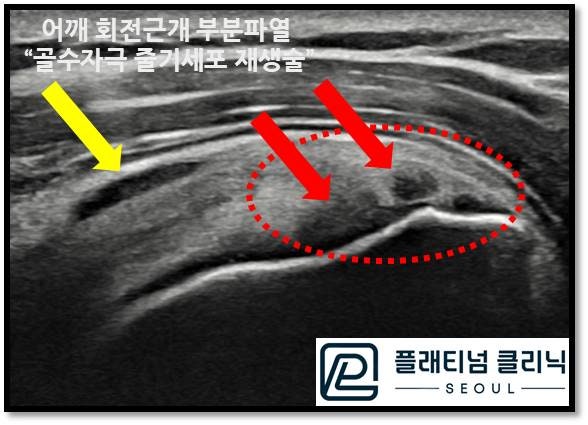 초음파에서는 정상 회전근개가 하얗게 보이며 빨간 원안에 검게 보이는 부위가 회전근개가 부분파열이 된 부위입니다. 노란 화살표로 표시된 부위는 파열로 인한 염증으로 염증성 물이 고여있는 것이 관찰됩니다.