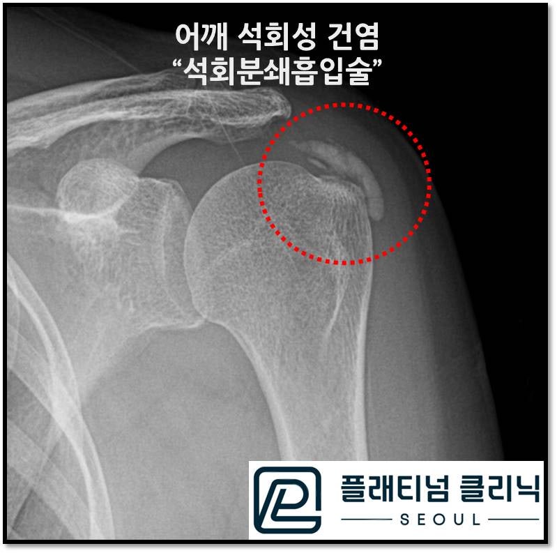 빨간 원안에 하얗게 뼈 위에 보이는 것이 석회입니다. 엄청나게 큰 석회가 관찰됩니다.