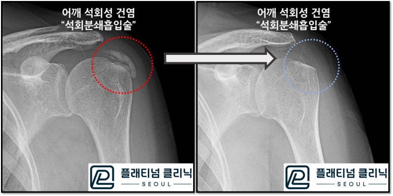 두 사진을 비교해 보면 빨간 원안의 석회가 파란 원안에는 거의 보이지 않는 것이 확연하게 관찰됩니다.