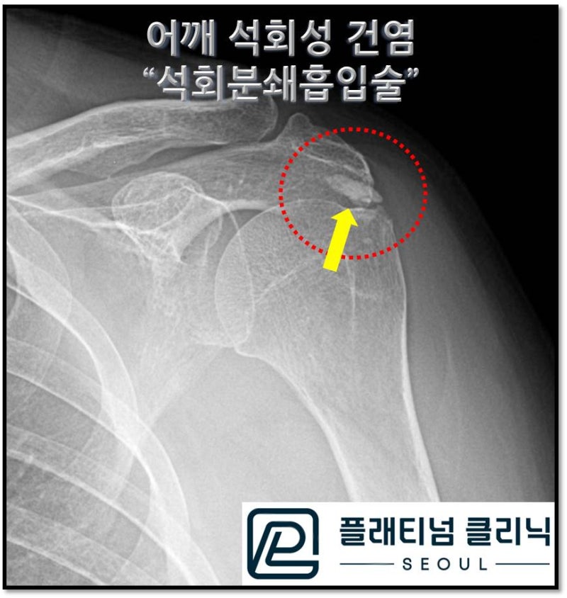 X-ray 를 보면 빨간 원안에 노란 화살표로 표시된 부위에 석회가 커다랗게 관찰됩니다.