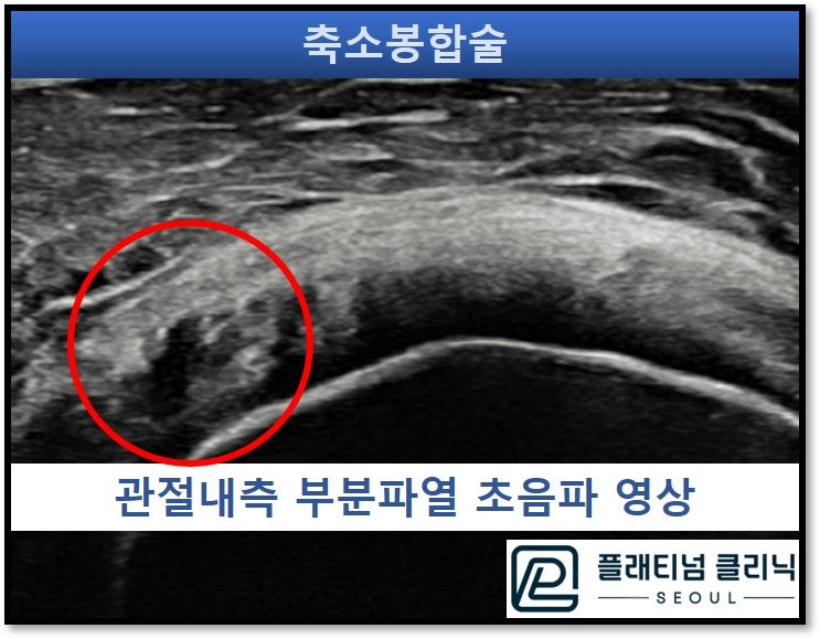 초음파 사진상 빨간 원안에 검게 보이는 부위가 회전근개 관절내측으로 부분파열이 발생된 것이 관찰됨.