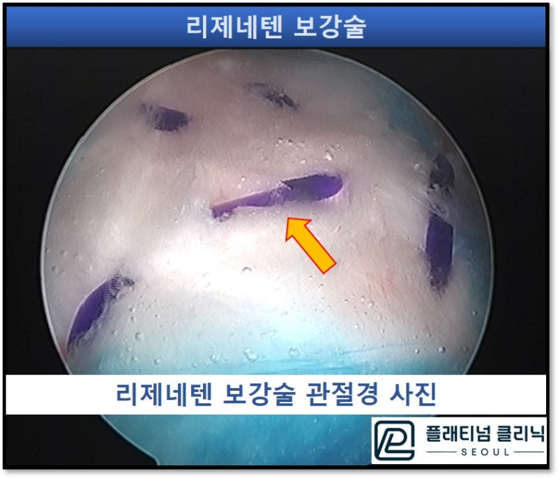 관절경사진상 전체적으로 하얗게 보이는 것이 리제네텐이며 주황색 화살표료 표시된 보라색 실이 리제네텐은 회전근개에 고정하는 것입니다.